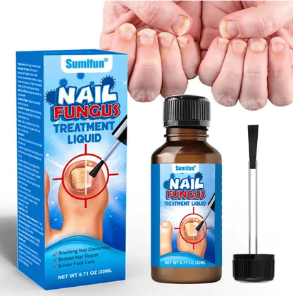 سائل لعلاج فطريات الأظافر