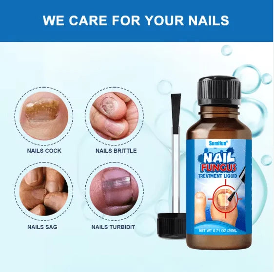 سائل لعلاج فطريات الأظافر